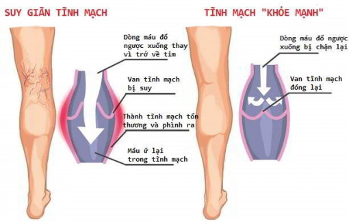 Điều trị laser có hết suy giãn tĩnh mạch chân?