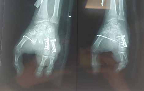 Người phụ nữ bị máy xay thịt cuốn nát 4 ngón tay, bệnh viện chuyển ngón chân lên thay thế
