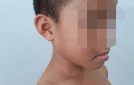 “Bảo mẫu” bạo hành khiến bé trai 6 tháng tuổi tổn thương não khai gì?