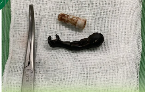 Gắp đầu bút và tay siêu nhân trong người bé gái 5 tuổi