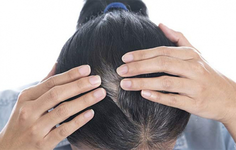 Ngăn chặn tóc bạc sớm với 4 việc đơn giản