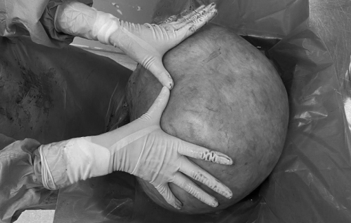 Tưởng mình tăng cân, người phụ nữ mang khối u 11kg suốt nhiều năm