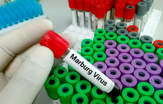 Các triệu chứng nghi ngờ bệnh do virus Marburg
