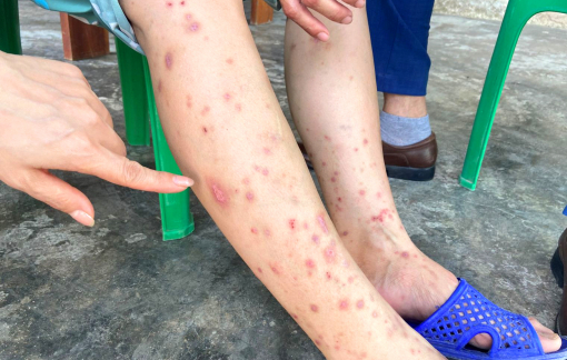 Hàng trăm người ở Hà Tĩnh bị côn trùng lạ tấn công, mẩn ngứa khắp người