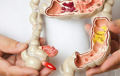 Chị gái bị ung thư, em phát hiện mắc hội chứng “đa polyp gia đình”