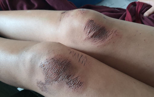 Nữ sinh lớp 6 bị kẻ trộm kéo trên đường