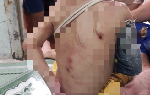 Bé trai hơn 1 tuổi trên người đầy thương tích nghi bị chích tàn thuốc, bạo hành