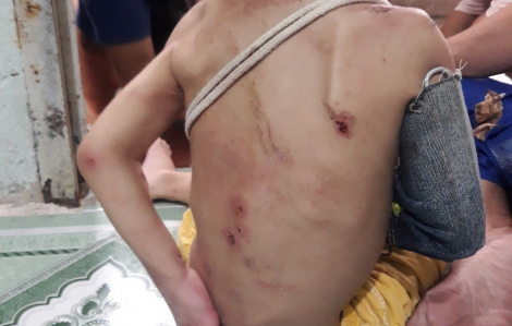 Vụ bé trai trên người đầy thương tích ở Hóc Môn: Người mẹ khai đánh con