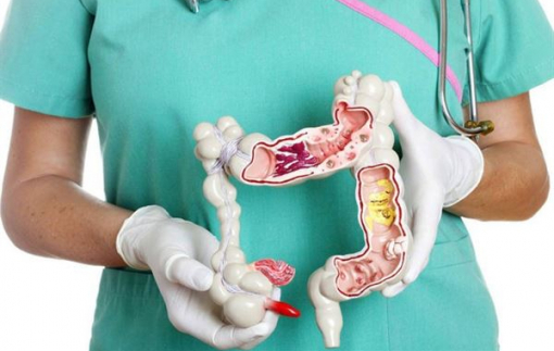 Sự gia tăng bí ẩn ung thư đại trực tràng ở người trẻ