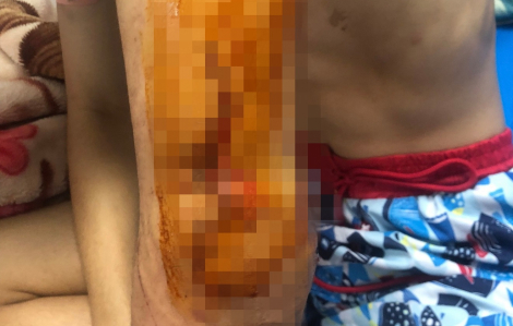 Đắk Lắk: 1 nam sinh lớp 10 bị đâm trọng thương 2 tay
