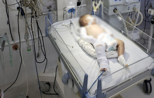 Bé gái 3 tháng tuổi nghi bị người tình của mẹ bạo hành gãy chân tay, chấn thương sọ não