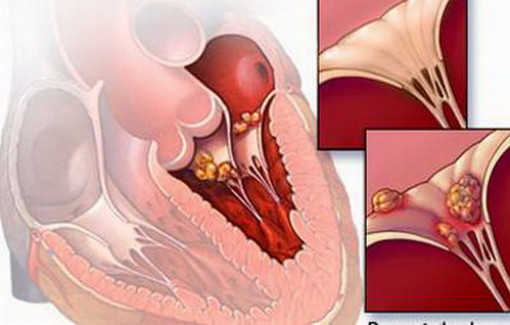 Trẻ sốt kèm thở mệt có nguy cơ bị viêm cơ tim không?