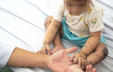 Việt Nam sắp có vắc xin phòng tay chân miệng