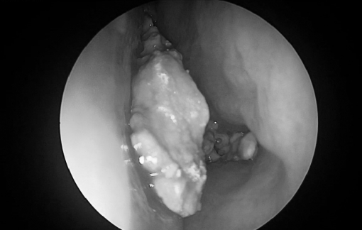 Viên sỏi lớn trong hốc mũi người phụ nữ hơn 30 năm