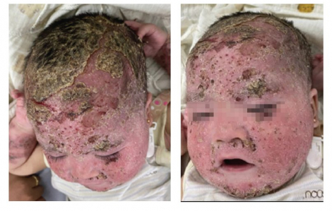 Bé trai 8 tháng tuổi da bị bong tróc, dát đỏ khắp mặt