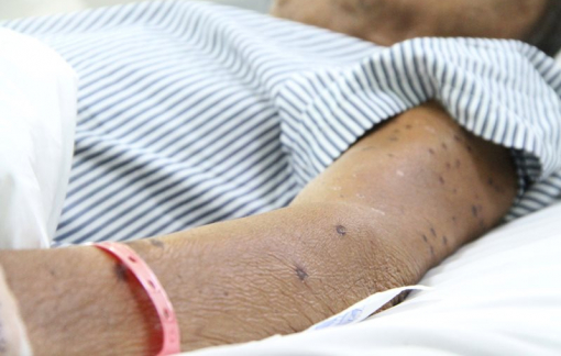 Cứu sống người đàn ông bị ong vò vẽ đốt hơn 120 vết ở Bạc Liêu