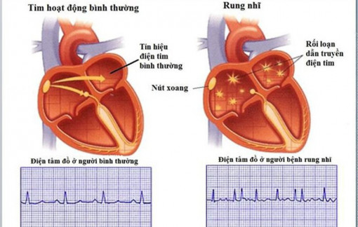 Căng thẳng, mất ngủ có liên quan bệnh rung nhĩ ở phụ nữ hậu mãn kinh