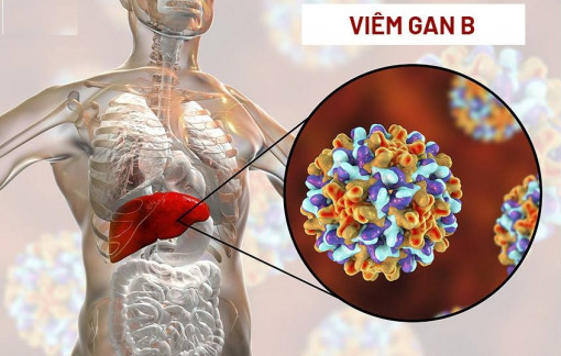 Viêm gan siêu vi B có cần điều trị?