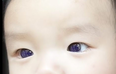 Đôi mắt của bé trai chuyển sang xanh sau 1 đêm điều trị COVID-19