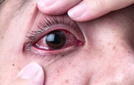 Sở Y tế TPHCM phối hợp đơn vị nghiên cứu của Đại học Oxford xác định tác nhân gây đau mắt đỏ
