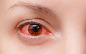 Infographic: Cách phòng ngừa đau mắt đỏ