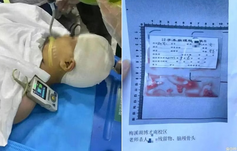 Trung Quốc: Bị thầy giáo đánh vào đầu bằng thước vuông, bé gái 9 tuổi vỡ sọ