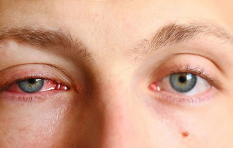 Miền Tây ghi nhận hàng ngàn ca bệnh đau mắt đỏ mỗi ngày