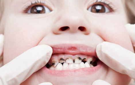 Có nên gây mê khi điều trị tủy răng cho trẻ em?