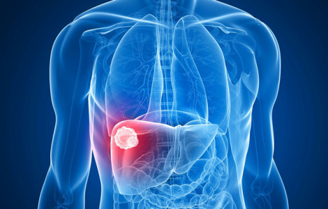 Có thể uống thuốc lá gia truyền điều trị ung thư gan?