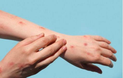 TPHCM đã ghi nhận 33 trường hợp mắc đậu mùa khỉ