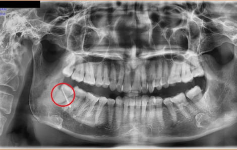 Có nên chủ động nhổ răng khôn?