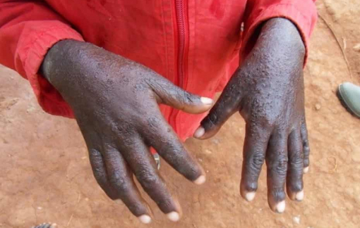 Bệnh ghẻ bùng phát ở Malawi