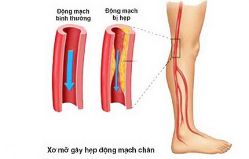 Tắc hẹp động mạch chi có nguy hiểm không?