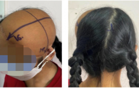 Bé gái 13 tuổi mọc tóc trở lại sau tai nạn mất gần hết da đầu