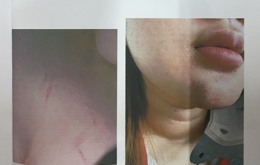 Nữ sinh ở Thủ Đức bị phụ huynh của bạn đánh bầm mình khắp người?