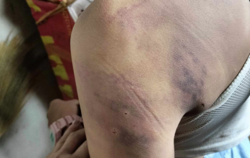 Xác minh vụ học sinh lớp 4 bị các bạn cùng lớp đánh