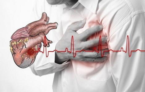 Đau thắt ngực là dấu hiệu của nhồi máu cơ tim?