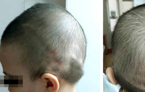 Tái tạo da đầu “mang” tóc đến cho người bệnh
