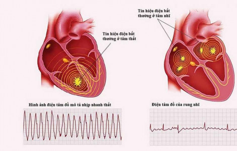 Trẻ bị rối loạn nhịp nhanh, can thiệp điện sinh lý tim được không?