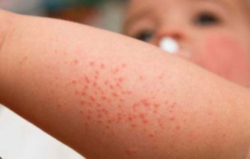 WHO cảnh báo mới về bệnh sởi