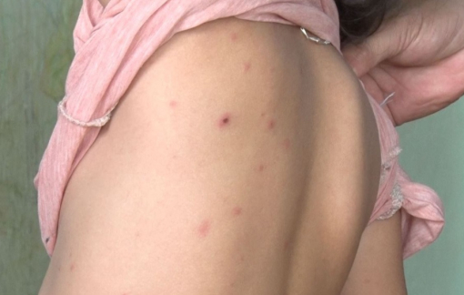 28 trẻ tại một trường mầm non ở Đắk Lắk mắc bệnh thủy đậu