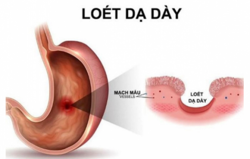 Ai dễ bị viêm loét dạ dày ngày tết?