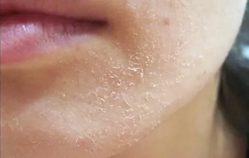 Làm gì khi da mặt bị sần sùi, lột da vì trời lạnh?