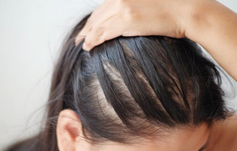 Phương pháp giúp tóc giảm tiết dầu, hạn chế bết dính