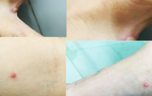Cà Mau chỉ đạo “nóng” sau khi có ca nghi mắc đậu mùa khỉ