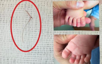 Bé gái 4 tháng tuổi suýt mất ngón chân vì sợi tóc rụng