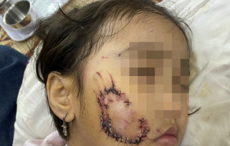 Bé gái 5 tuổi bị chó cắn phải khâu gần 50 mũi