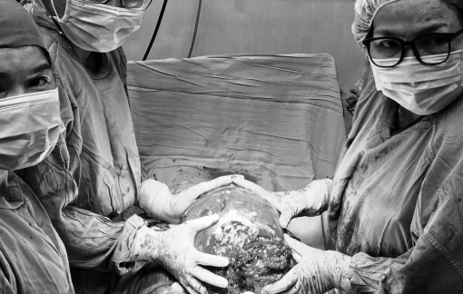 Phẫu thuật song hành, cắt khối u xơ tử cung và mổ lấy thai