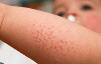 Trẻ sinh mổ cần tiêm 2 liều vắc xin sởi