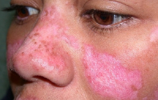 Bệnh lupus ban đỏ, uống thêm thuốc đông y được không?